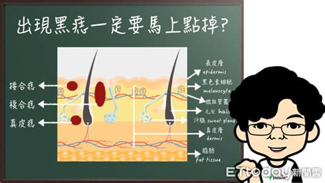 痣長毛|黑痣長毛、顏色不均？別亂點痣！5步驟分別黑色素瘤